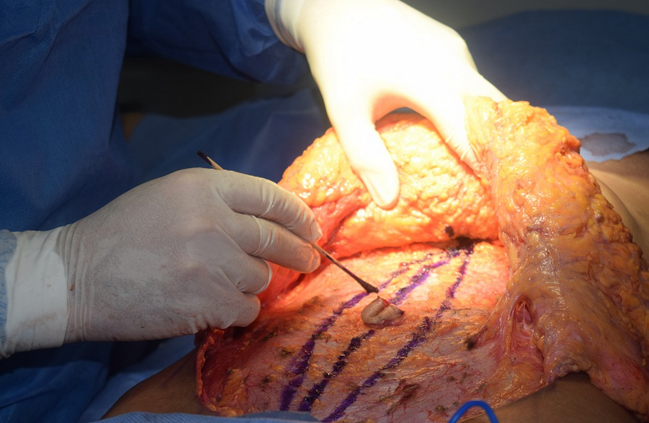tummy tuck